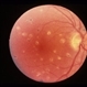 Avulsion of the Optic Nerve OD