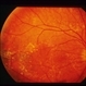 Sudden Vision Loss