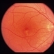Idiopathic Choroidal Neovasculization (CNV)