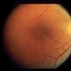 Cystoid Macular Edema (CME)