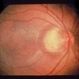 Retinoblastoma To Chemothermotherapy