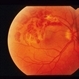 Blurring Of Central And Inferior Visual Field