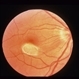Superior Paracentral Scotoma