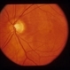 Idiopathic Polypoidal Choroidal Vasculopathy