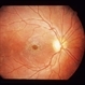 Stellate Maculopathy