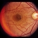 Bilateral Serous Detachments