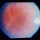 Retinal Detachment Of The Macula