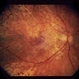 Nummular Depigmented Or Atrophic Pigment Epithelium