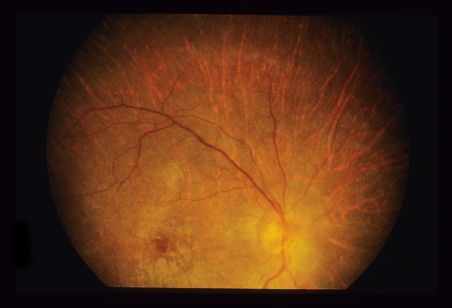 retinal degeneration icd 10