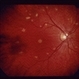 Decreased Visual Acuity (Case 2)