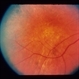 Lymphomatoid Granulomatosis