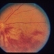 Optic And Hyperemic Disc And Hyperemic Rim