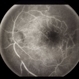 Retinal Vascular Occlusive Disease