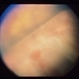 Intraocular Inflammation