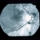 Sub-Arachnoid Hemorrhage