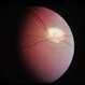 Optic Nerve Hypoplasia