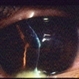 Corneal Laceration / Repeat Trauma