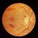 Acute optic nerve edema due to JODM