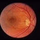 Acute Macular Neororetinitis Acute Macular Neororetinitis