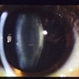 Dilated Slit Lamp Exam