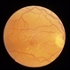 Macular Drusen