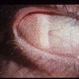 Dermoid, Epibulbar