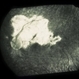 Paracentral Blind Spot And Scotoma