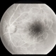 Retinal Vascular Occlusive Disease