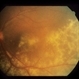 Intraocular Inflammation