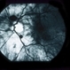 Sub-Arachnoid Hemorrhage