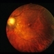 Congenital Cataracts