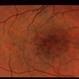 Acute Macular Neororetinitis Acute Macular Neororetinitis
