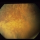 Intraocular Inflammation