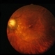 Congenital Cataracts