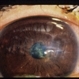Corneal Laceration / Repeat Trauma