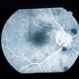 Sub-Arachnoid Hemorrhage