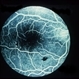 Diabetes with Flame Hemorrhage FA