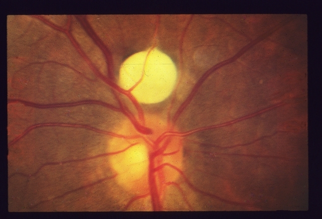 Retinal cyst Retinal Cyst? - Retina Image Bank