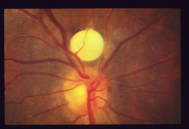 Retinal Cyst? - Retina Image Bank