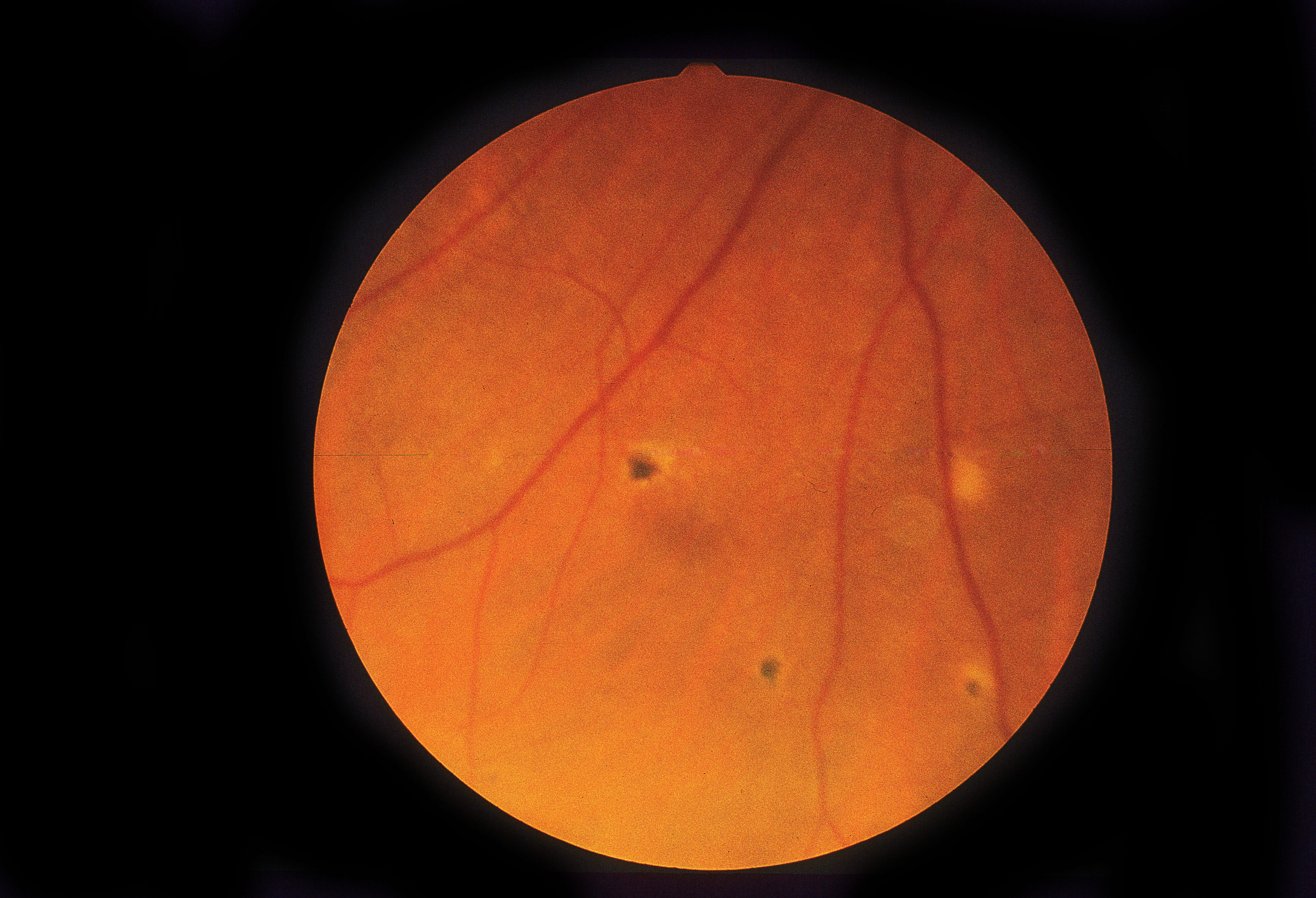 scar in eye retina