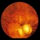 Congenital Cataracts