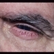 DR Rubeosis