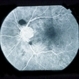 Sub-Arachnoid Hemorrhage