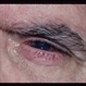 DR Rubeosis