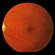 ARMD  RPE Defect / Myelinated NFL
