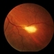 ARMD  RPE Defect / Myelinated NFL