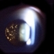 Asteroid Hyalosis Asteroid Hyalosis