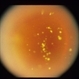 Asteroid Hyalosis Asteroid Hyalosis