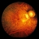 Congenital Cataracts