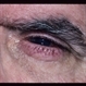 DR Rubeosis